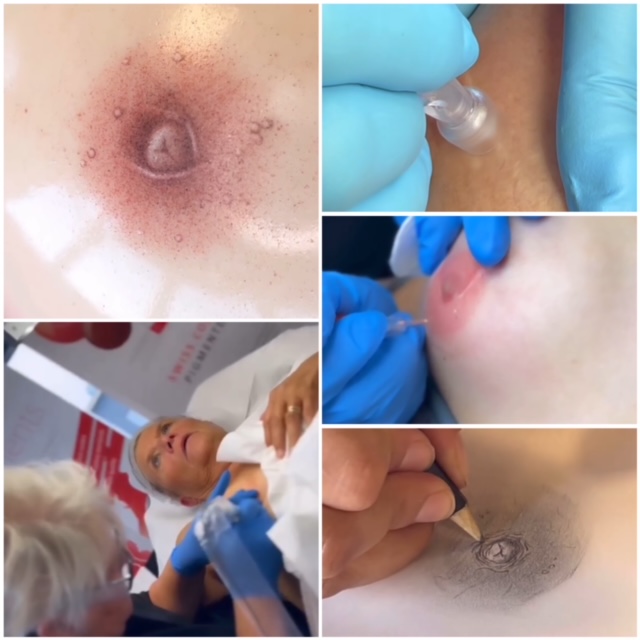 3D medische pigmentatie & Microneedling (MED)